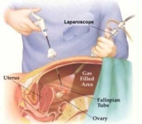 Laparoscopic surgery/SurgiCam story